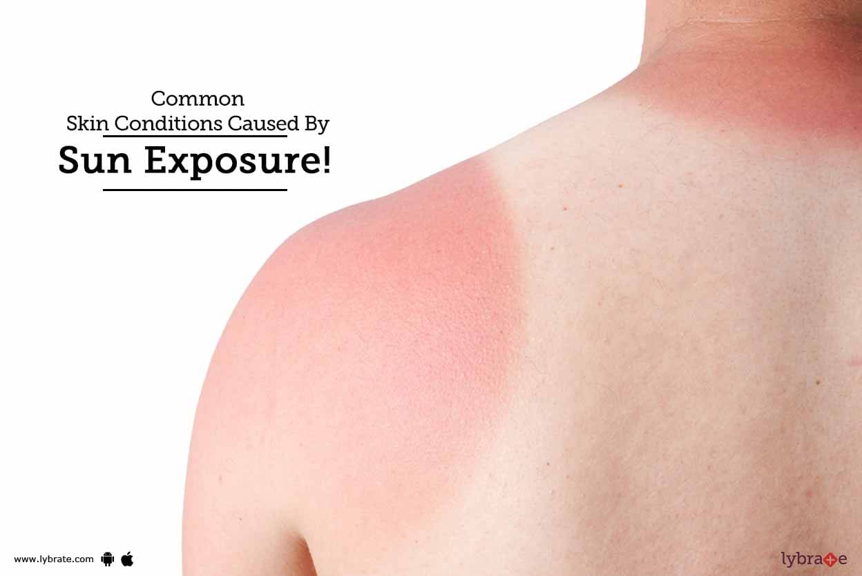 common-skin-conditions-caused-by-sun-exposure-by-dr-ramesh-gosavi