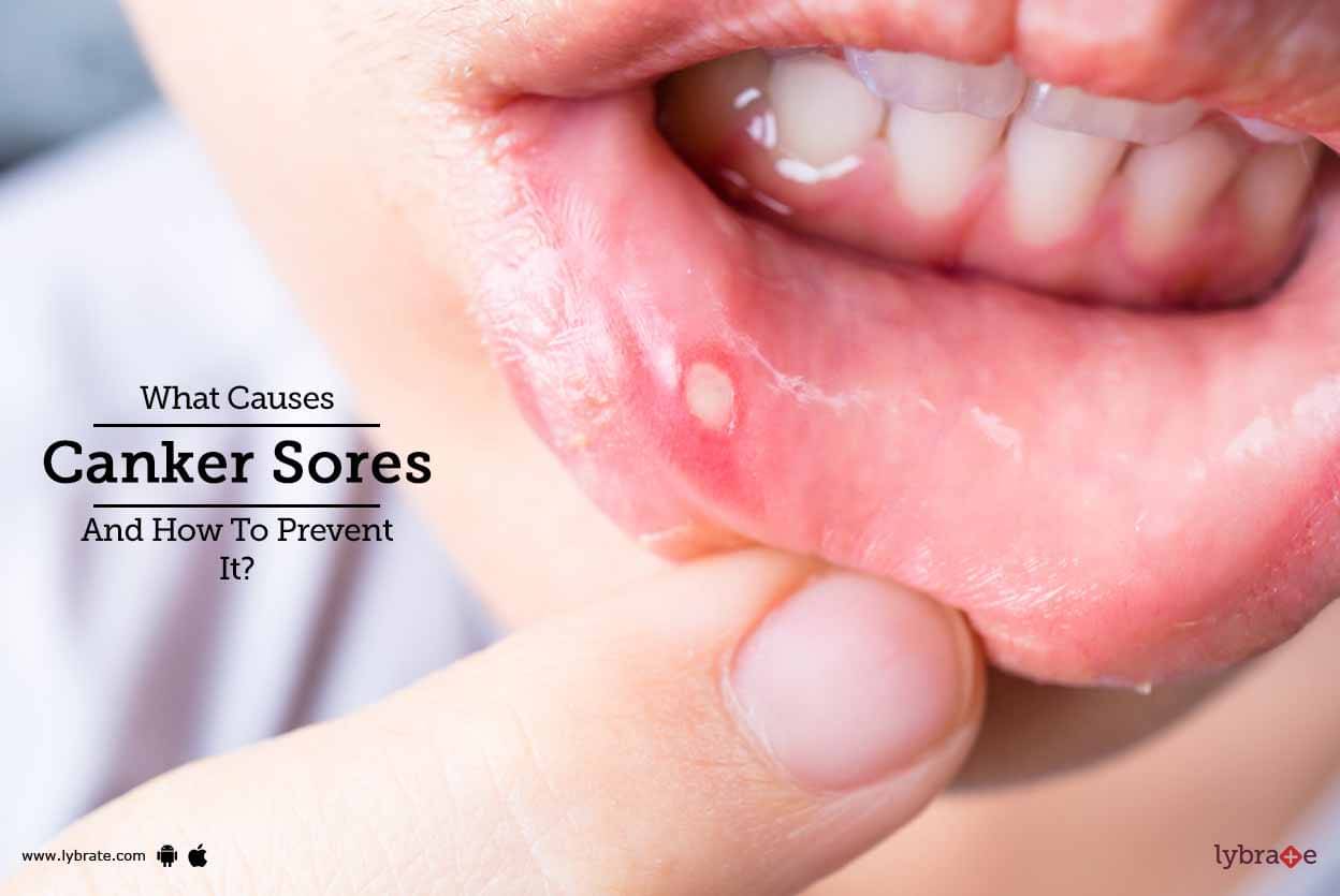 What Causes Canker Sores And How To Prevent It By Dr Ruchi Lohia