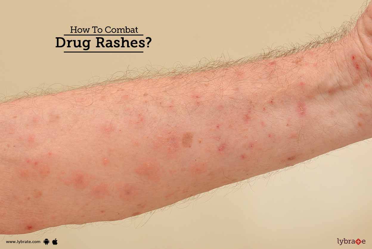 How To Combat Drug Rashes By Dr Saravananbn Lybrate