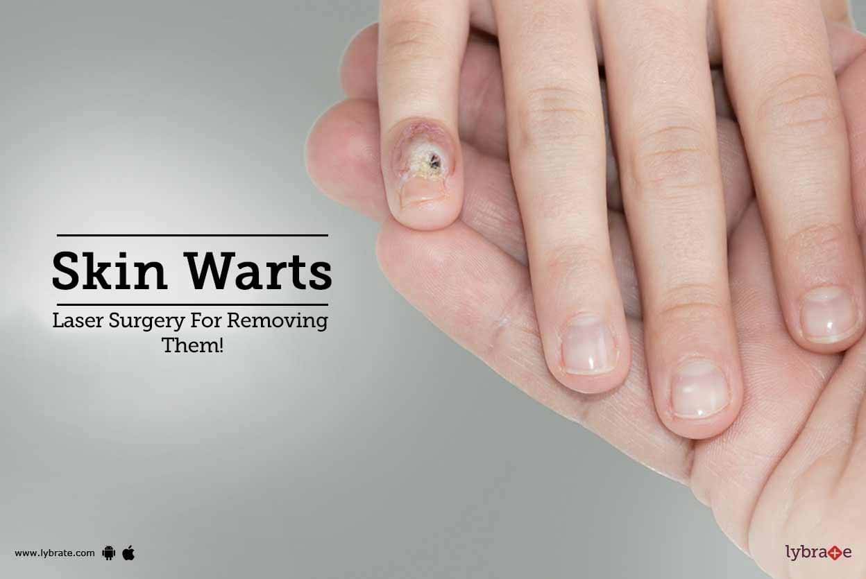 skin-warts-laser-surgery-for-removing-them-by-skinovate-laser