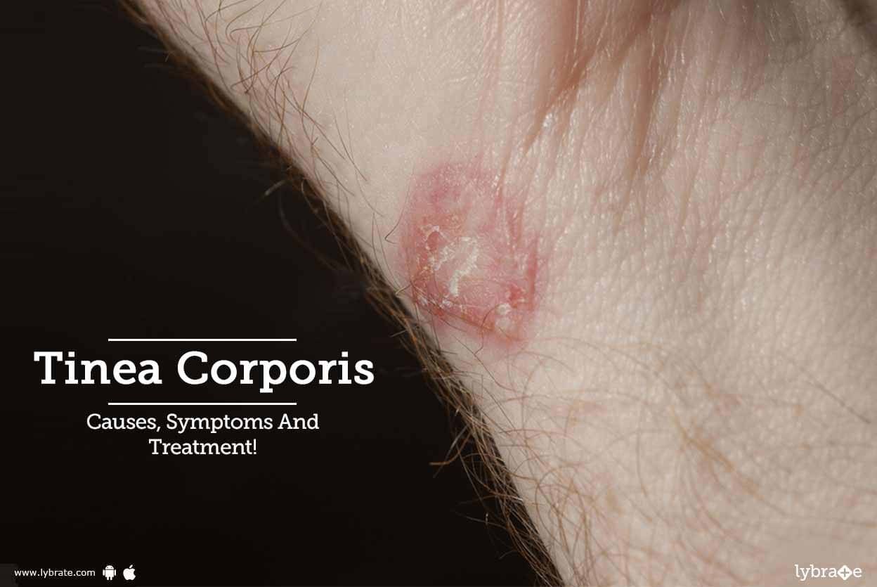 Tinea Corporis - Causes, Symptoms And Treatment! - By Sakhiya Skin ...