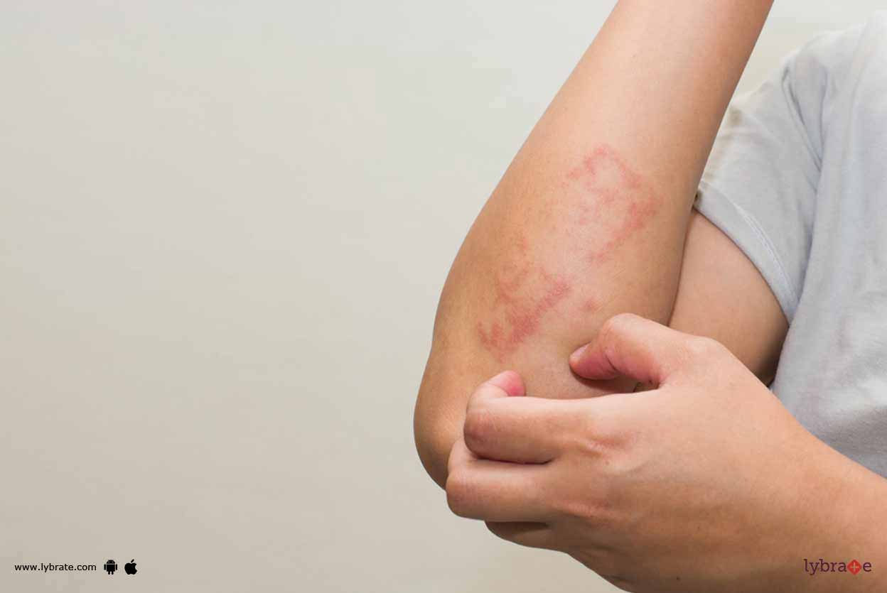 Autosensitization Dermatitis - Symptoms And Treatment Of It! - By Dr ...
