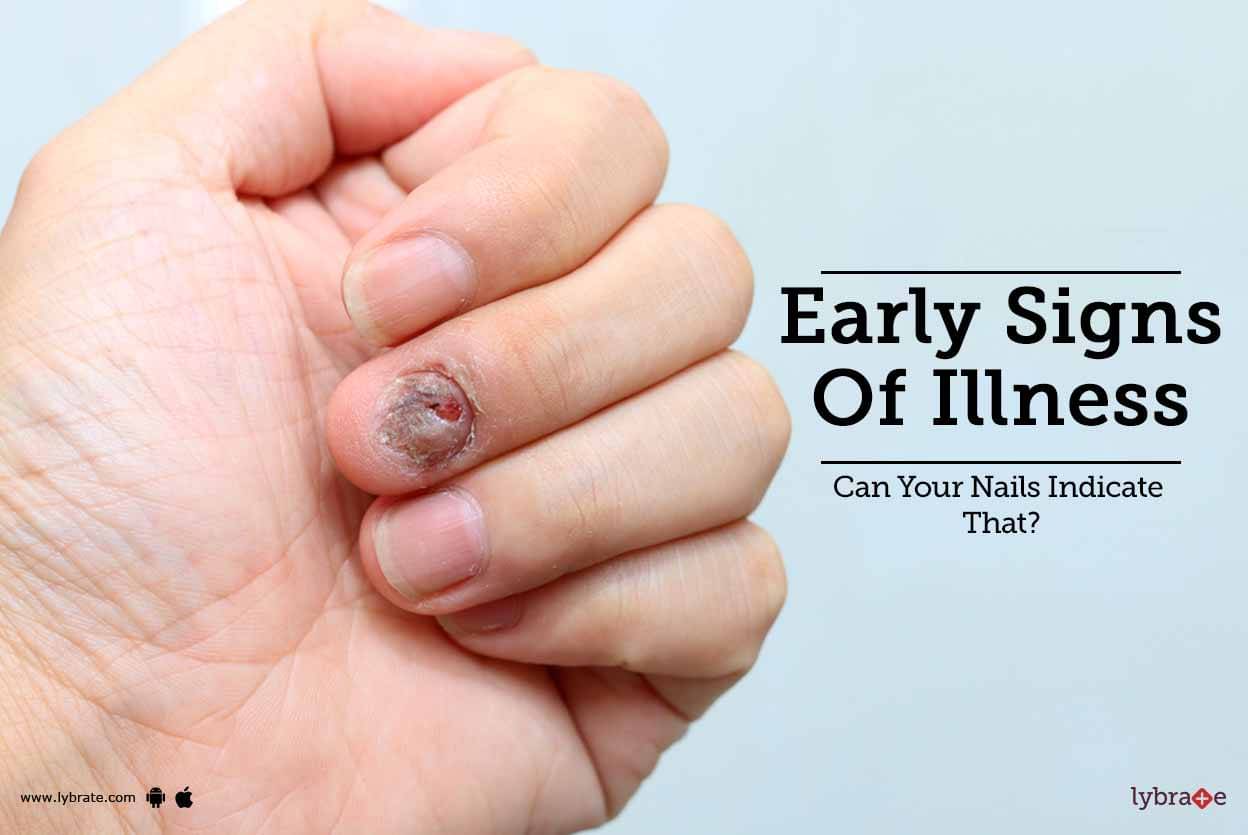 Signs Of Illness In Your Nails