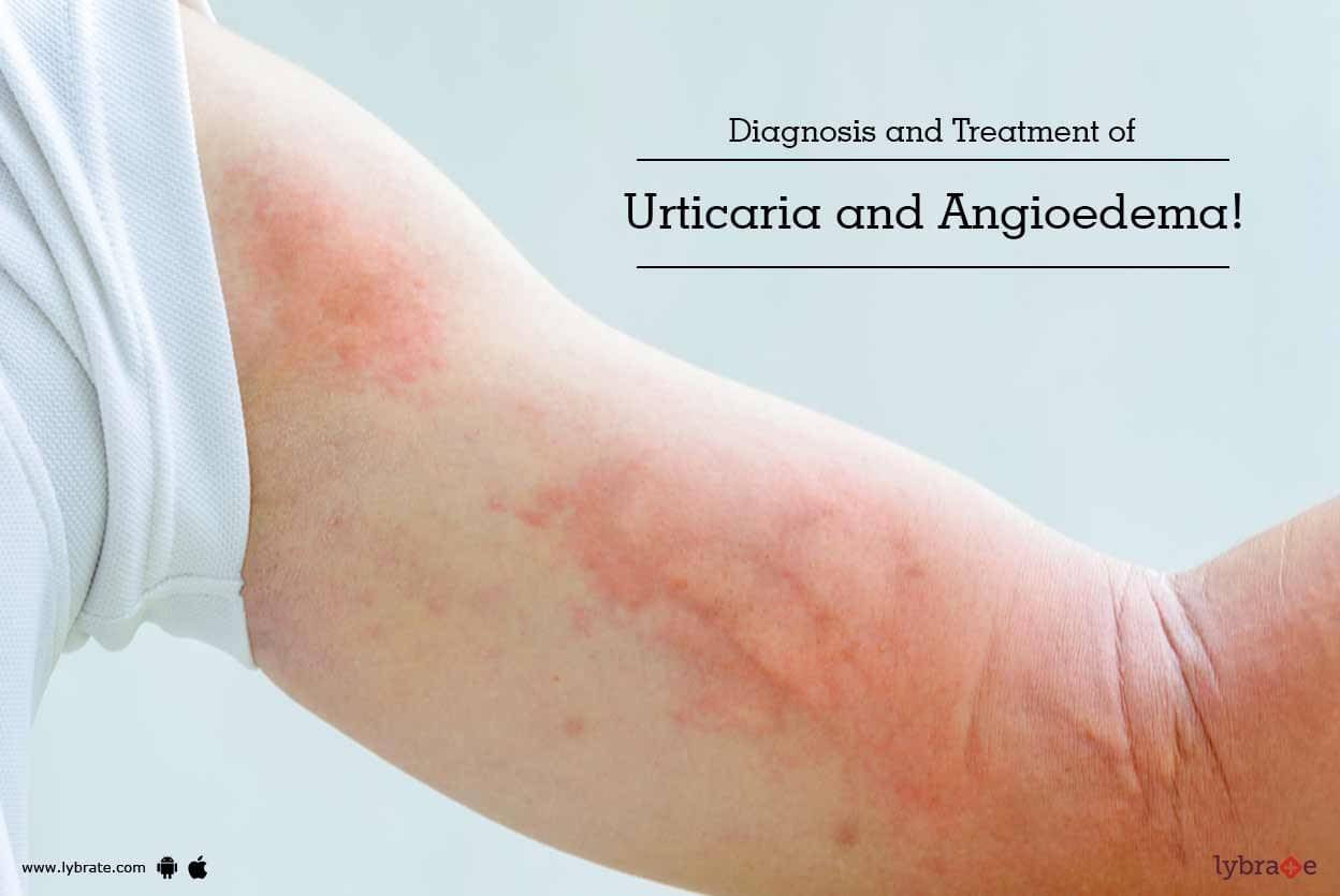 Chronic Urticaria And Angioedema 