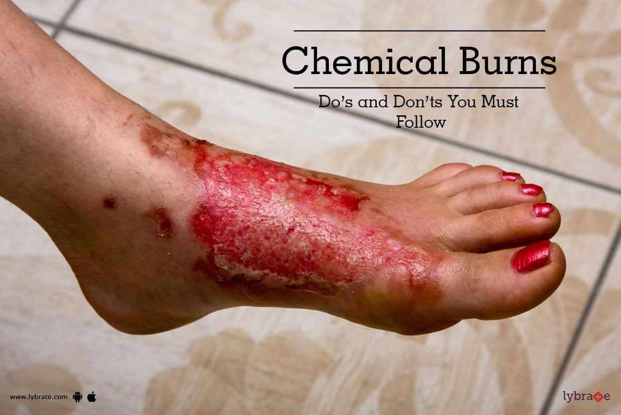 Chemical Burns - Do's and Don'ts You Must Follow - By Dr ...