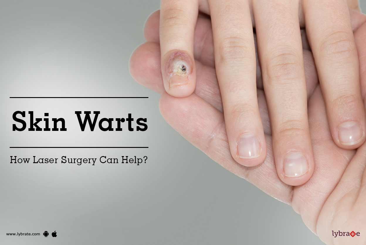 sucking-anal-warts-surgery-recovery-white-cotton