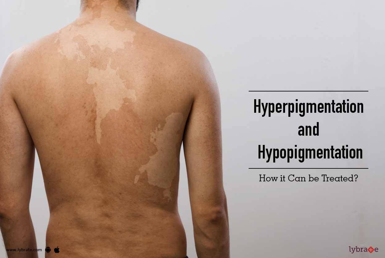 Hyperpigmentation and Hypopigmentation - How it Can be Treated? - By Dr