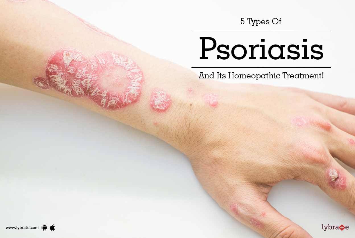 5 Types Of Psoriasis And Its Homeopathic Treatment By Dr Nikhil