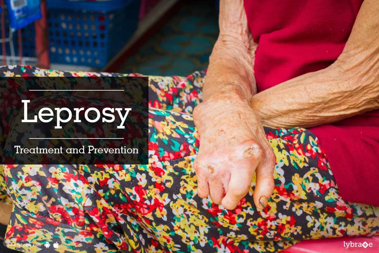 Leprosy - Treatment And Prevention! - By Dr. (Col.)Anil Goyal | Lybrate