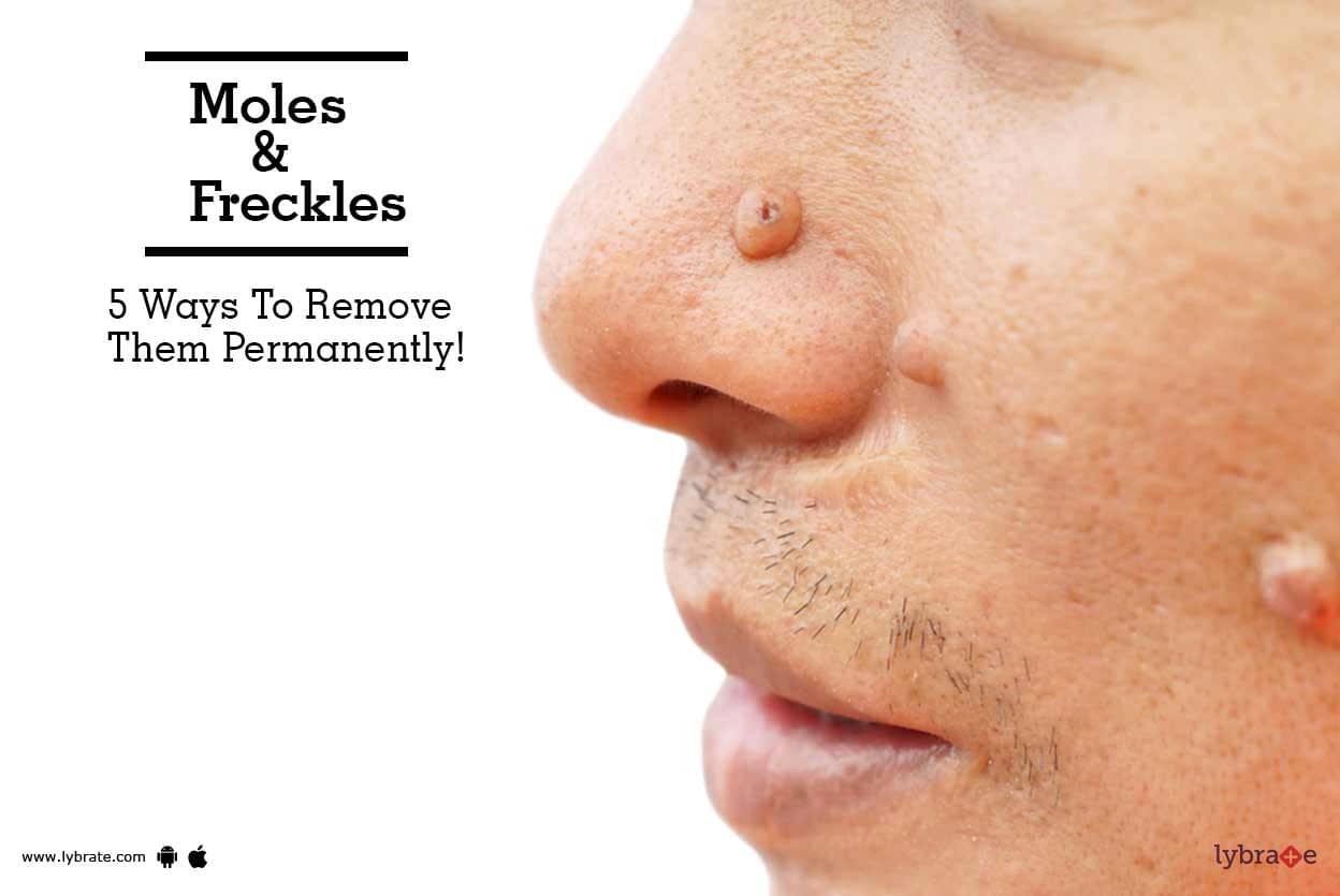 moles-freckles-5-ways-to-remove-them-permanently-by-dr