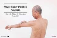 White Scaly Patches On Skin Can It Be A Sign Of Seborrheic Dermatitis 