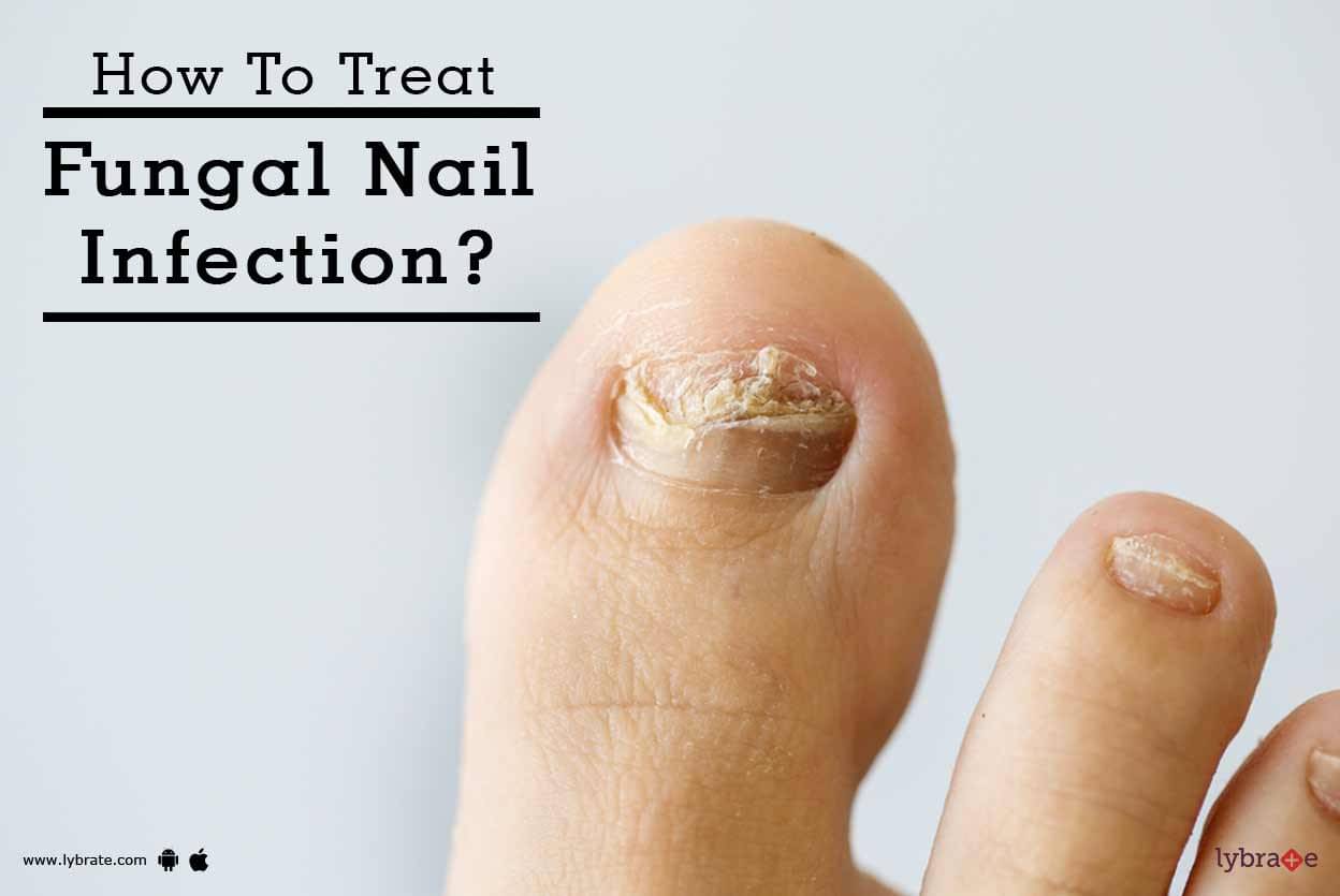 how-to-treat-fungal-nail-infection-by-dr-akhilesh-shukla-lybrate