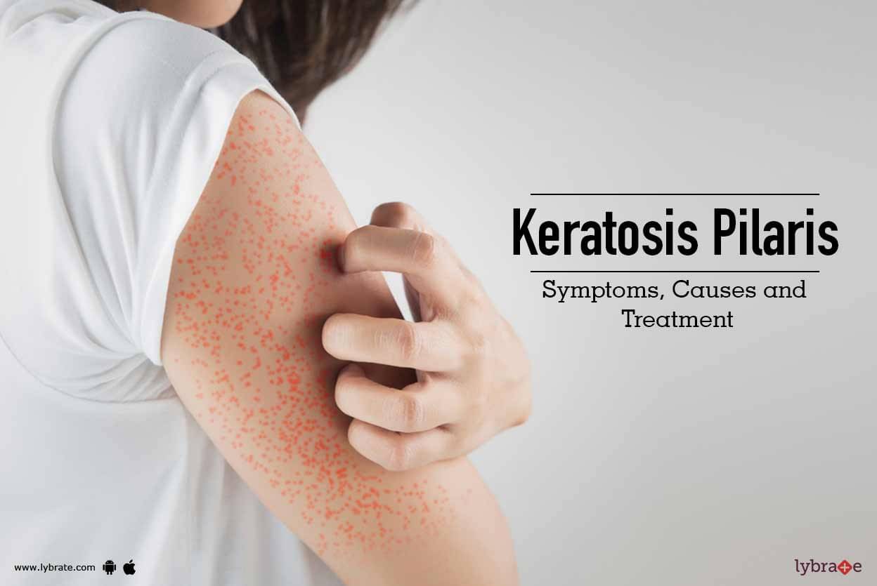 Keratosis Pilaris - Symptoms, Causes And Treatment - By Dr. Nivedita ...