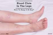 What Do Blood Clots Look Like In Your Legs At Joanne Andrade Blog