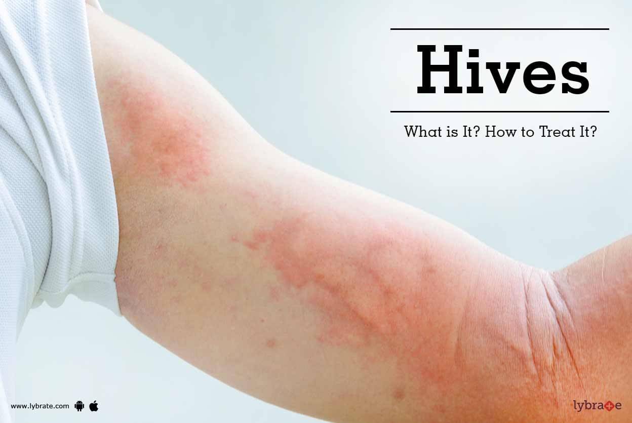 hives-what-is-it-how-to-treat-it-by-dr-vikas-shankar-lybrate