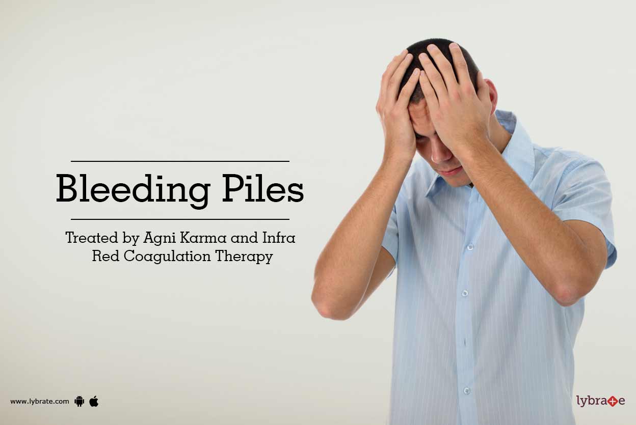 Bleeding Piles Treated by Agni Karma and Infra Red Coagulation Therapy