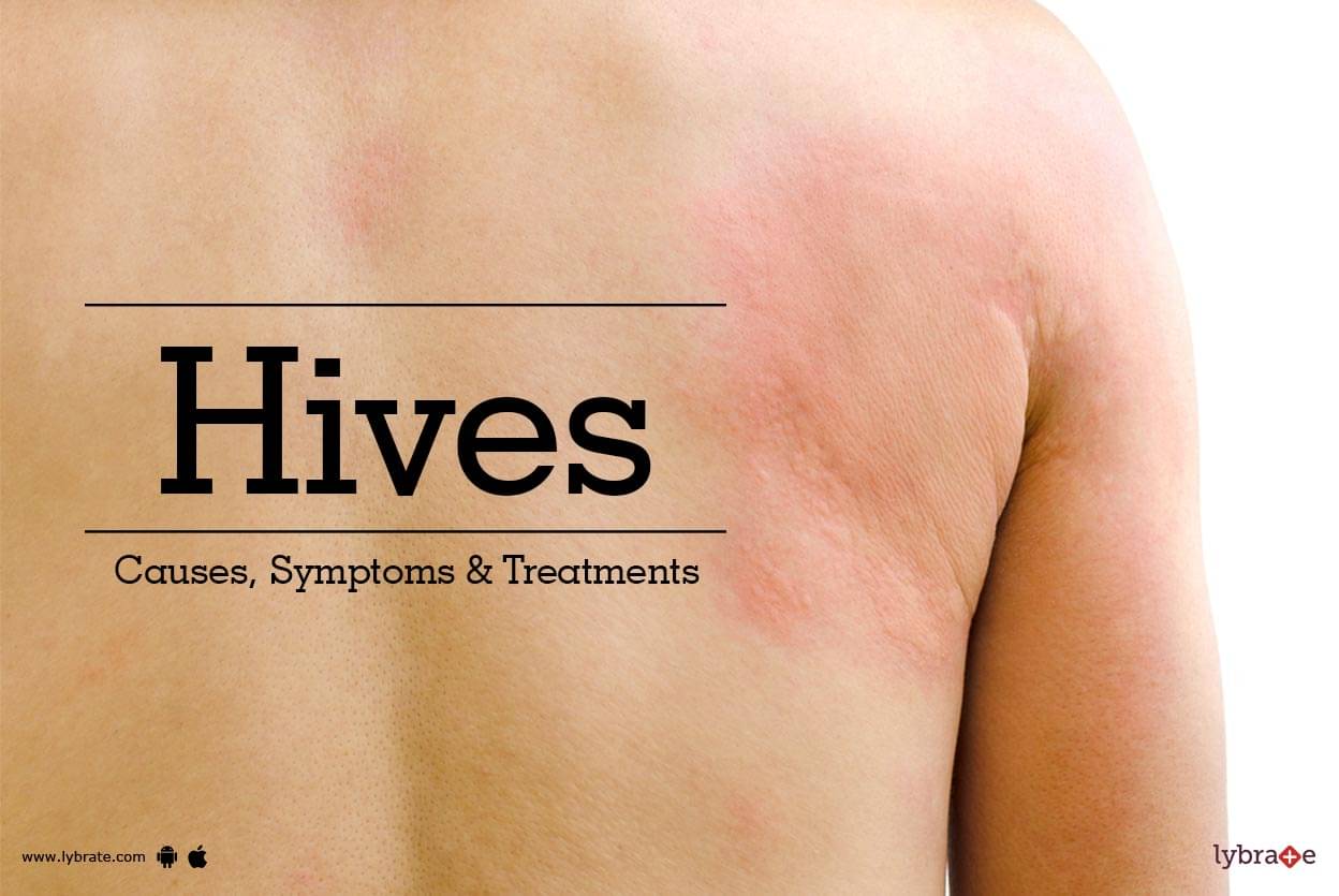 Hives Causes Symptoms And Treatments By Dr Shivashankar B Sajjanshetty Lybrate 7366