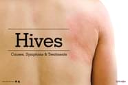 Hives Causes Symptoms Treatments By Dr Shivashankar B 