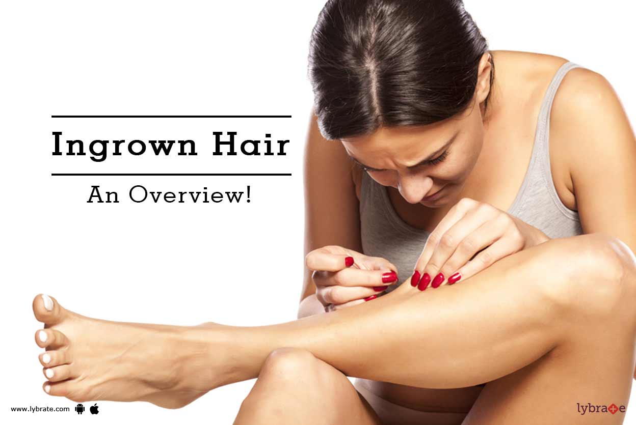 Ingrown Hair An Overview By Dr Archit Aggarwal Lybrate