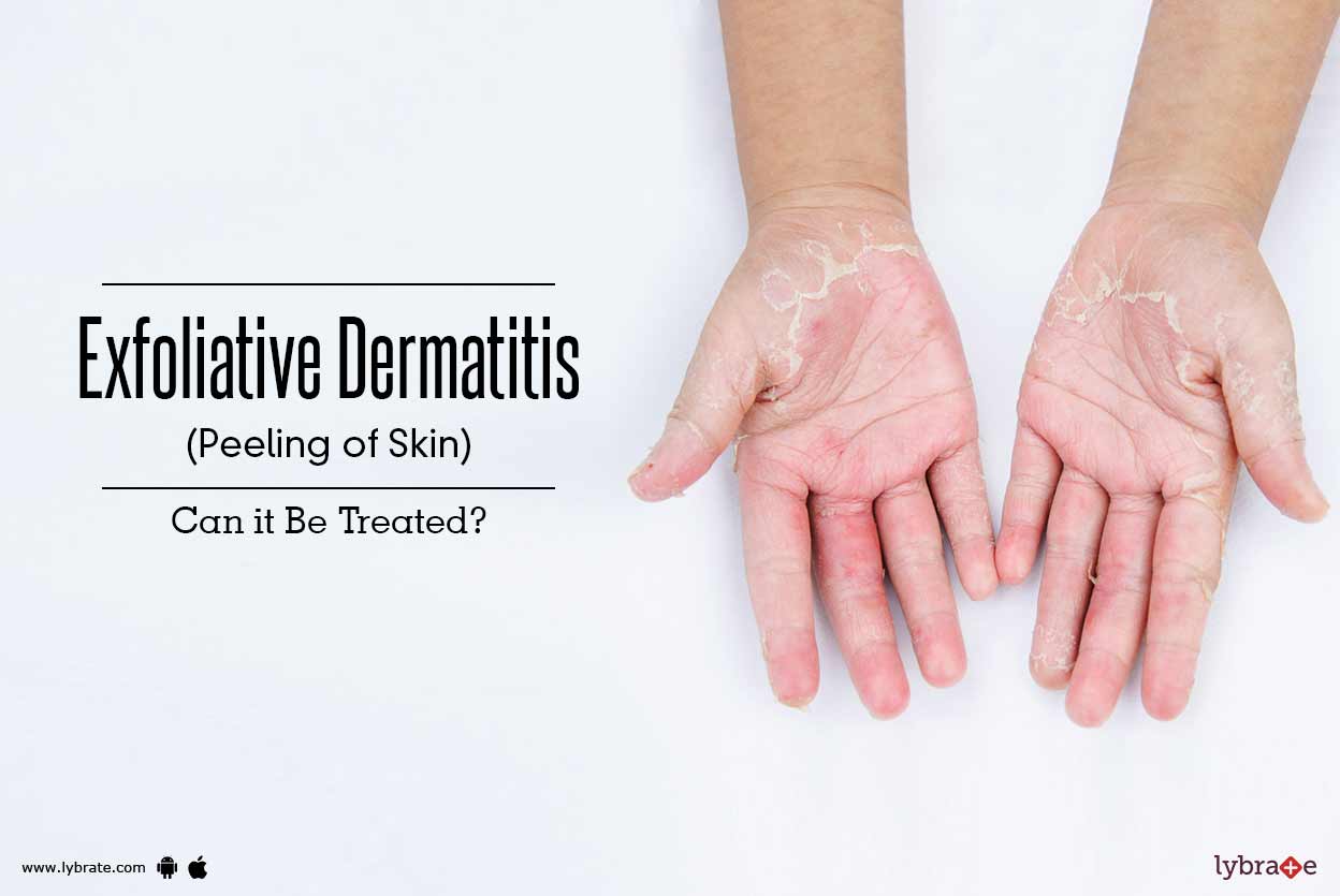 Exfoliative Dermatitis (Peeling of Skin) Can it Be Treated? By Dr