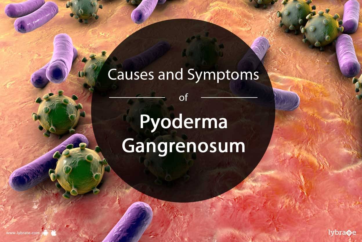 t d skin p treatment of Pyoderma By Symptoms Gangrenosum Dr and  Causes