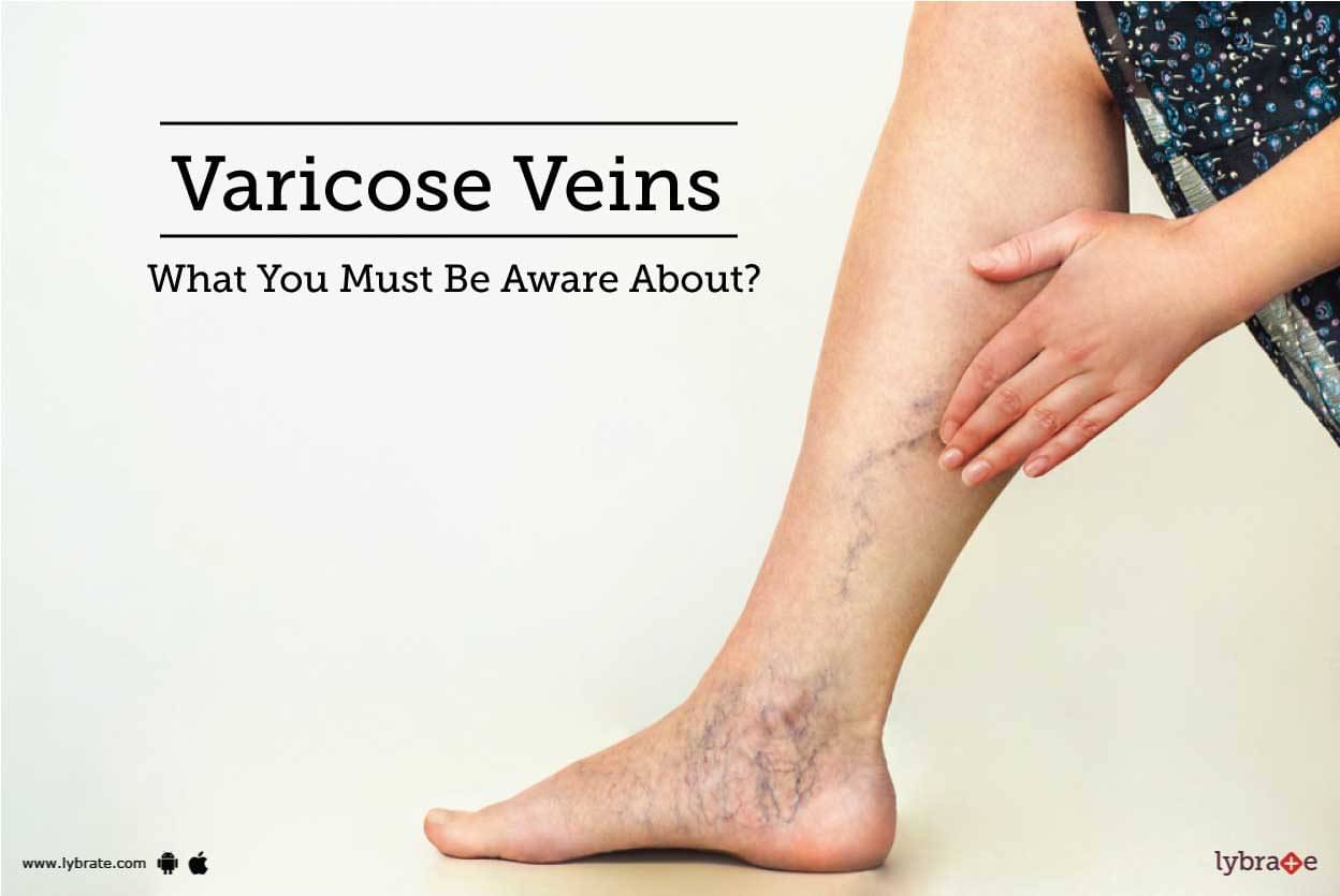 Varicose Veins & Chronic Venous Insufficiency! - By Dr. Pravin Narkhede ...