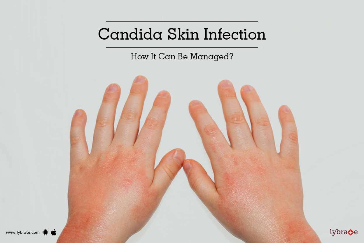 Candidiasis Skin Rash Treatment 