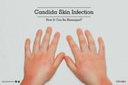 Candida Skin Infection How It Can Be Managed By Dr V Sethu Raman 