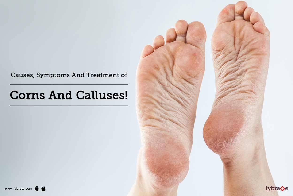 Causes, Symptoms And Treatment Of Corns And Calluses! - By Dr. Sarita ...