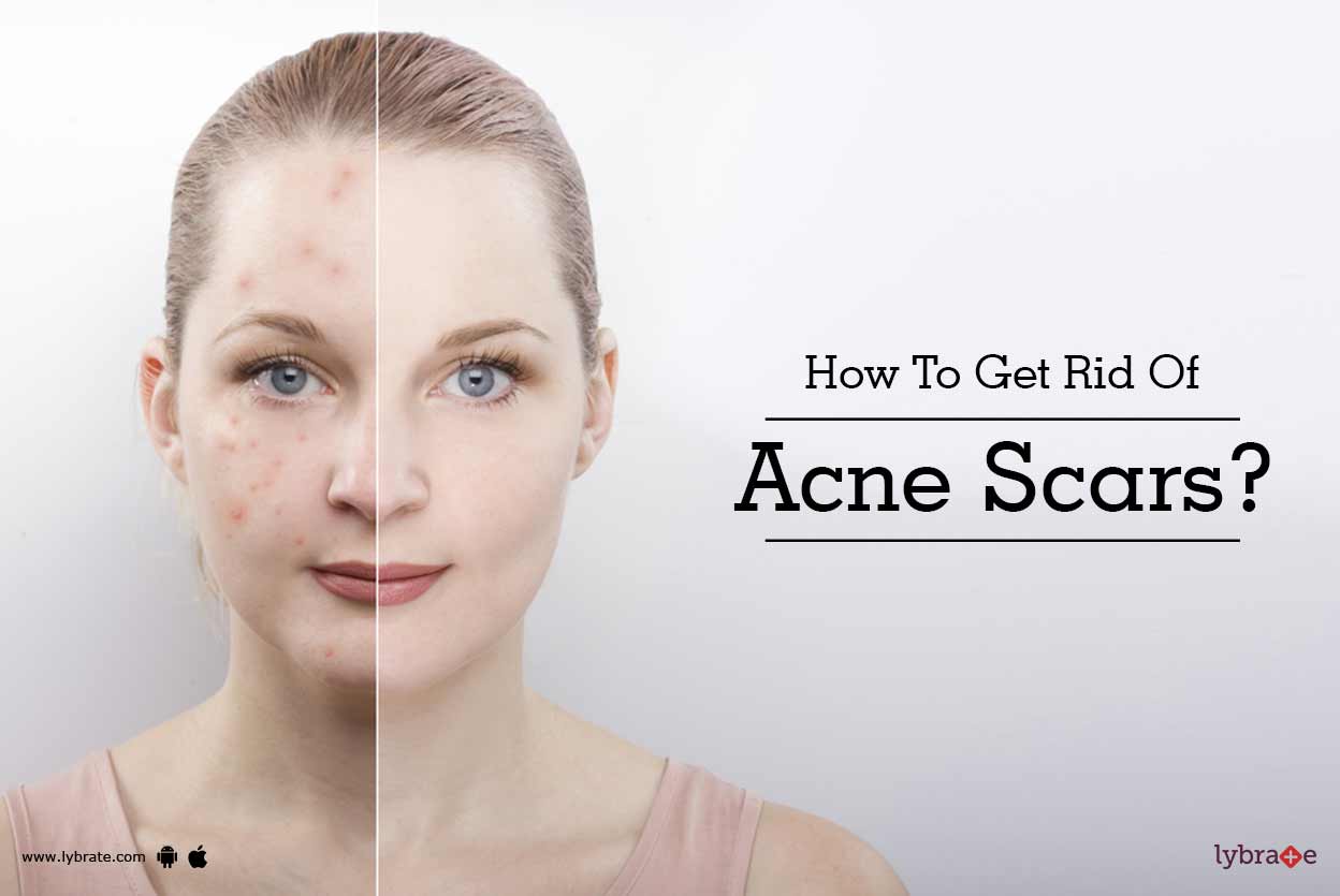 How To Get Rid Of Acne Scars? By Dr. Atul Jain Lybrate