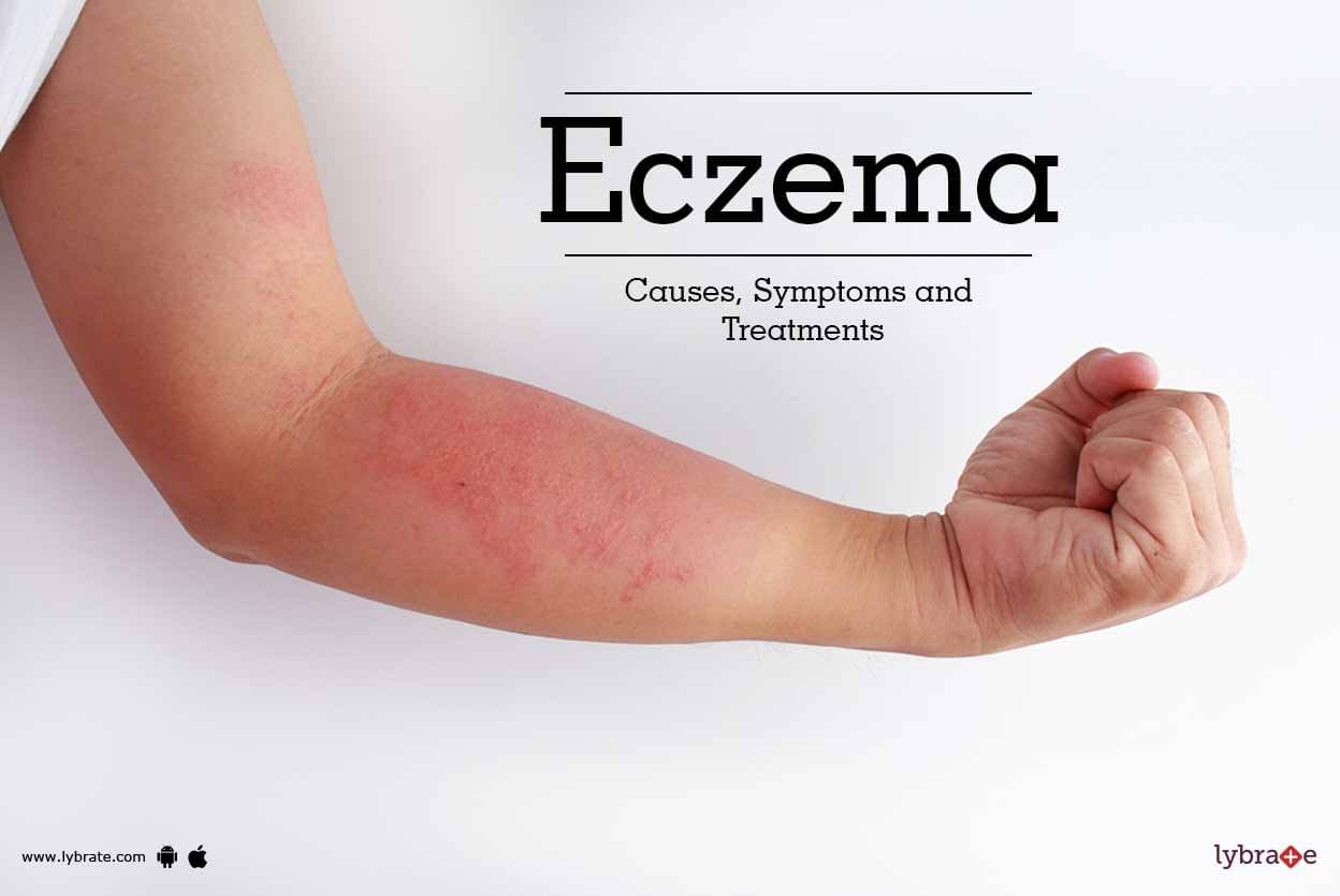 Eczema - Causes, Symptoms and Treatments - By Dr. Himanshu Singhal