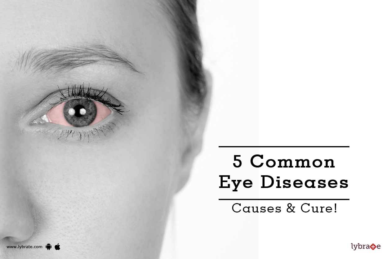 5 Common Eye Diseases Causes And Cure By Dr Ruchi Lybrate