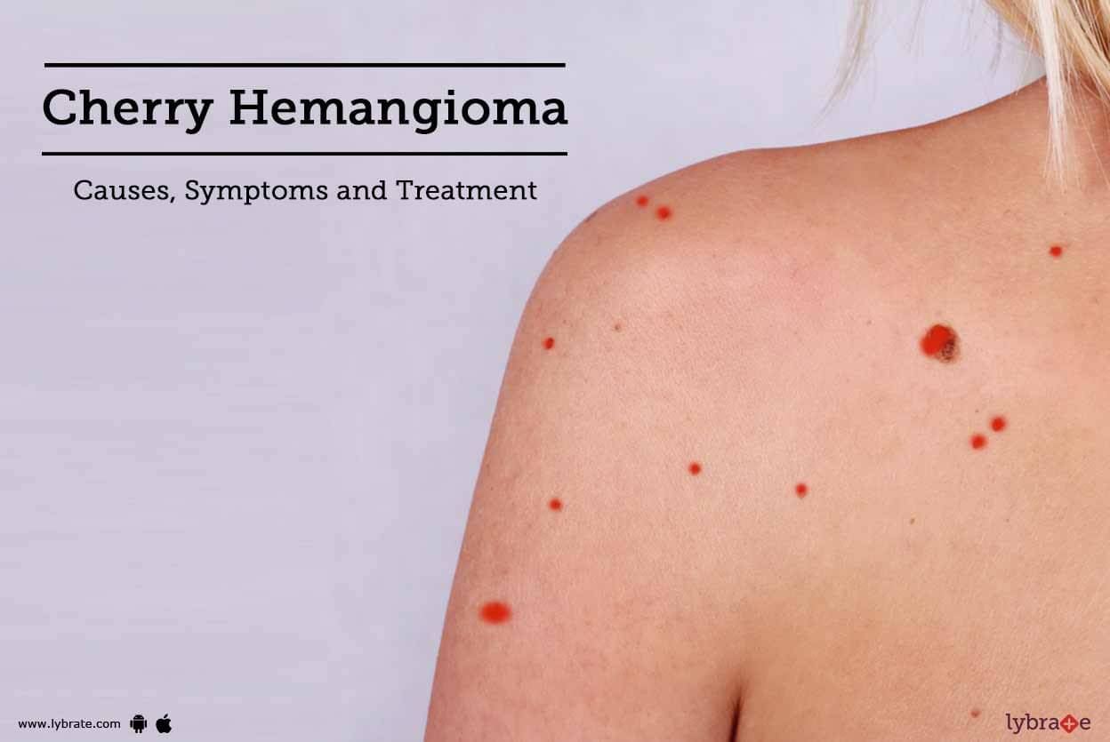 Cherry Hemangioma Causes Symptoms And Treatment By Dr Gunjan Shah Lybrate 3412