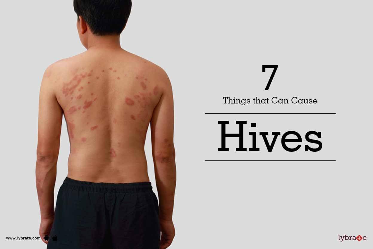 7 Things That Can Cause Hives - By Dr. Shivashankar B. Sajjanshetty ...