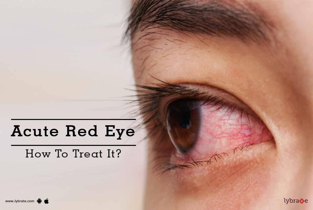 Acute Red Eye How To Treat It By Dr Sanjay Sen Lybrate