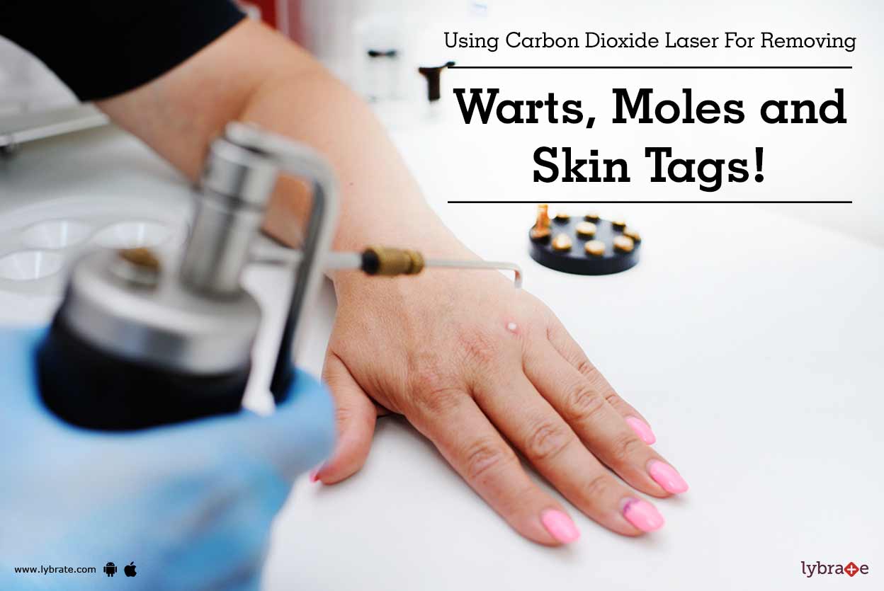 Using Carbon Dioxide Laser For Removing Warts, Moles and Skin Tags! By Dr. Sangeeta Varma