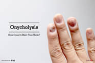 Onycholysis How Does It Affect Your Nails By Dr Umesh Bilewar 