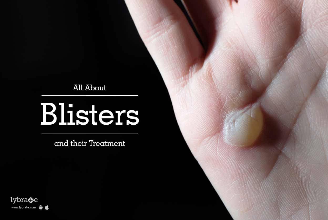 all-about-blisters-and-their-treatment-by-dr-umesh-alegaonkar-lybrate