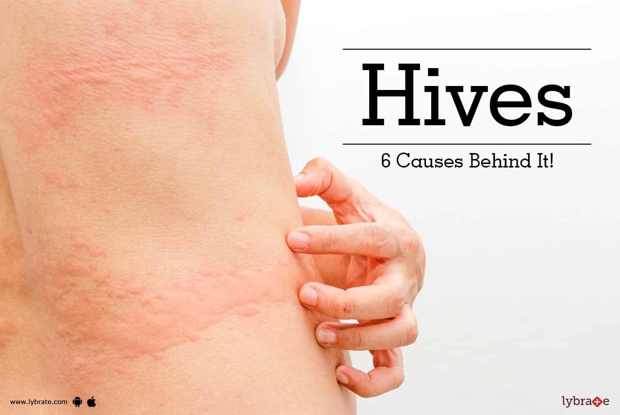 Hives Rash Or Urticuria 6 Cause Behind Skin Disorder By Kaya Skin