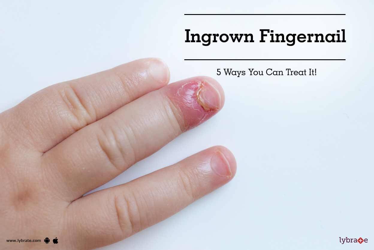 Ingrown Fingernail 5 Ways You Can Treat It By Dr Sruthi Gondi Lybrate