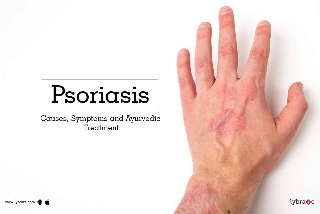 cause psoriasis