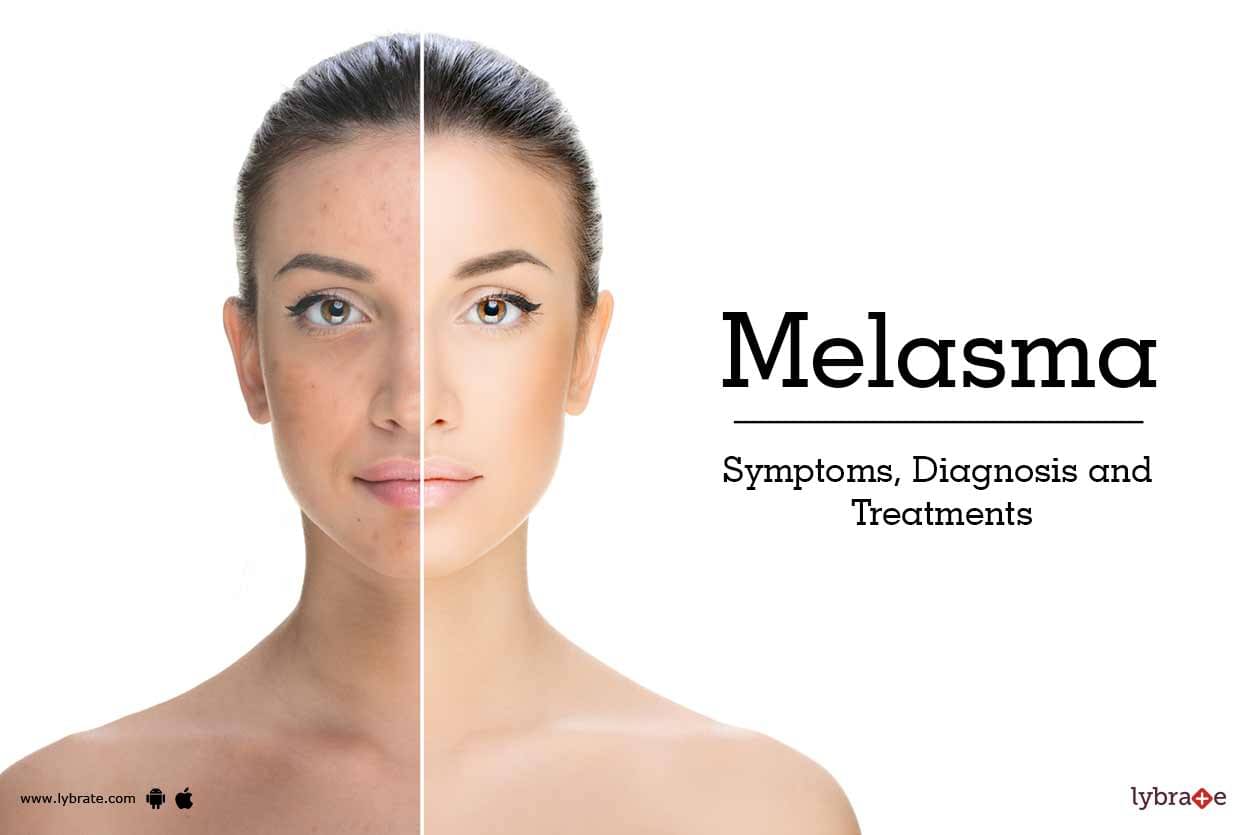 Melasma: Symptoms, Diagnosis and Treatments - By Isaac 