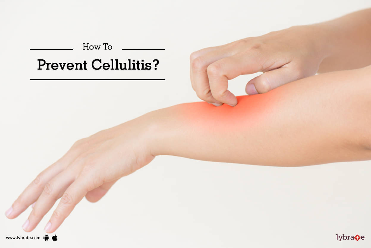 How To Prevent Cellulitis? - By Dr. Sandesh Gupta Lybrate