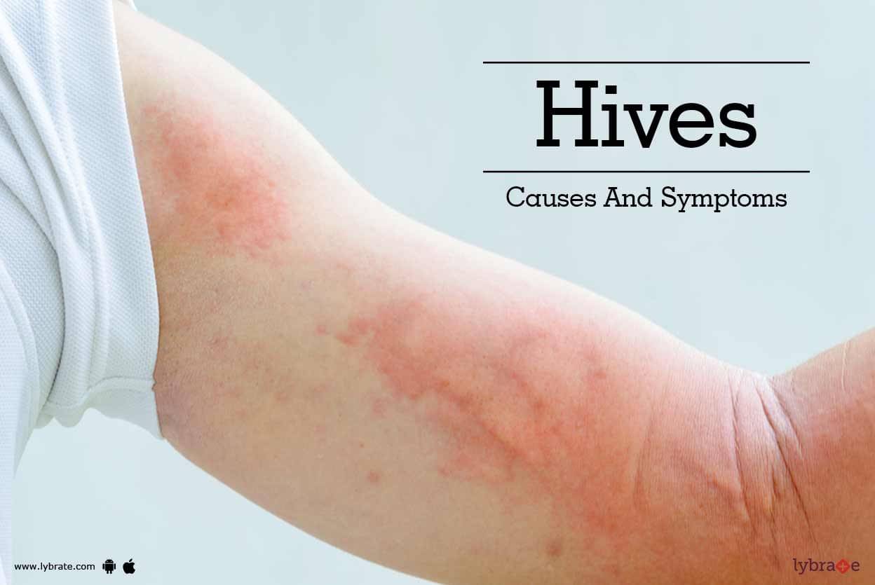 Hives Causes Treatment And Conditions Wiki Itchy Mind Images