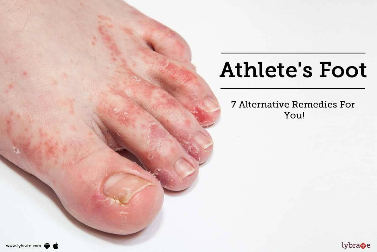 Athlete’s Foot - 7 Alternative Remedies For You! - By Dr. Neeraj Gupta