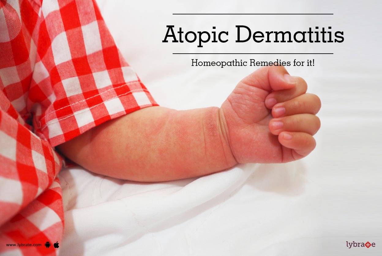 Atopic Dermatitis Homeopathic Remedies For It By Dr Pulak Mukherjee Lybrate