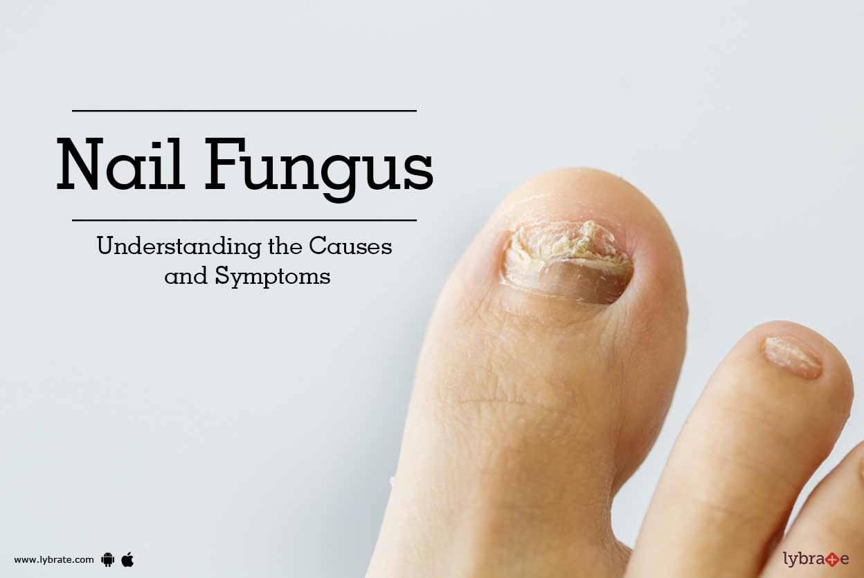 Nail Fungus - Understanding the Causes and Symptoms - By Kaya Skin ...