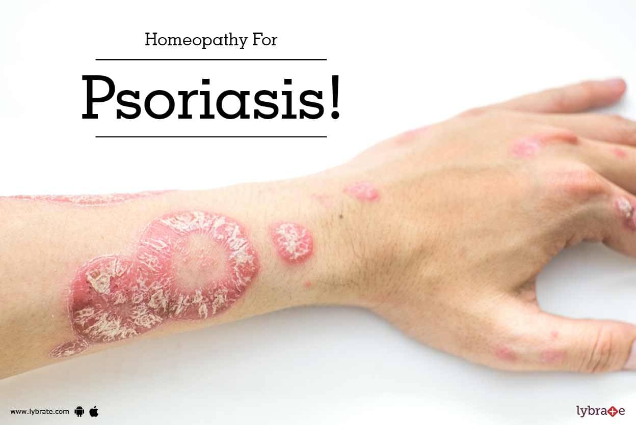 guttate psoriasis treatment in homeopathy