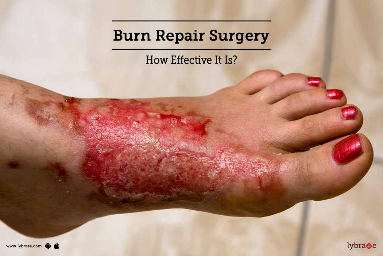 46++ Verbrennung 2 grades bilder , Burn Repair Surgery How Effective It Is? By Dr. Ashutosh Shah Lybrate