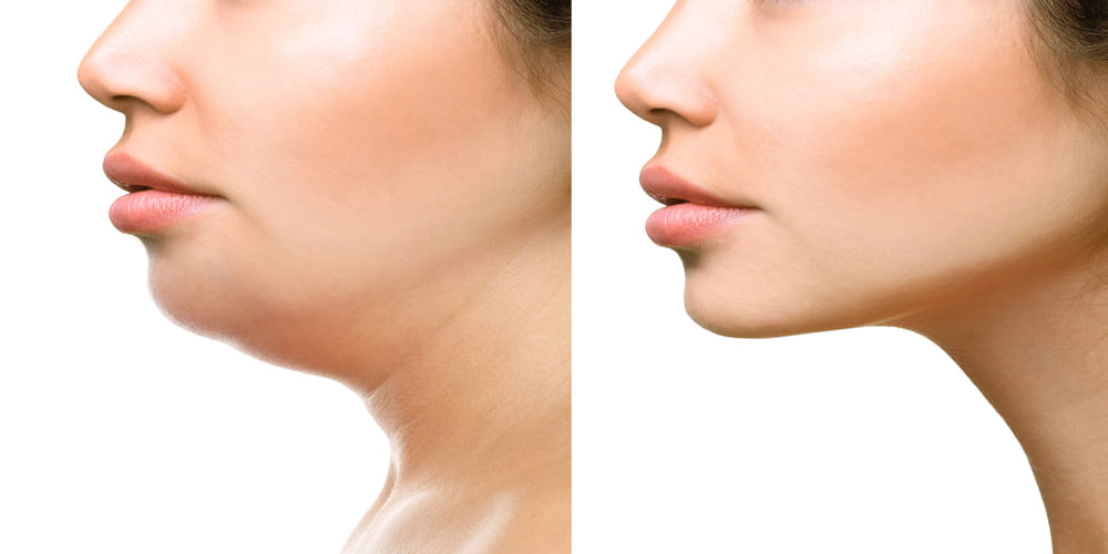 Non-Surgical Jaw Slimming Procedure!